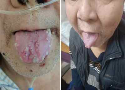 目前乳腺癌来一个治好一个 ——广西百色杨忠雅