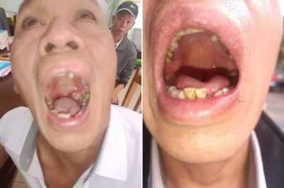 目前乳腺癌来一个治好一个 ——广西百色杨忠雅