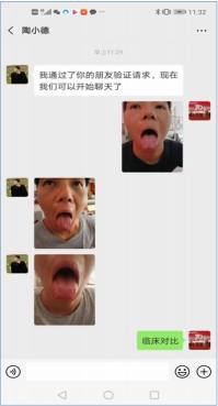 广西中医特色疗法传承导师——梁爱瑟