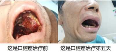 尿毒症乳腺癌不讲价钱凭良心给广西百色杨忠雅